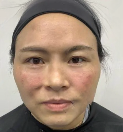 去眼袋手术