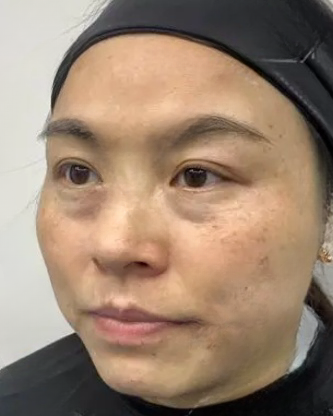 去眼袋手术
