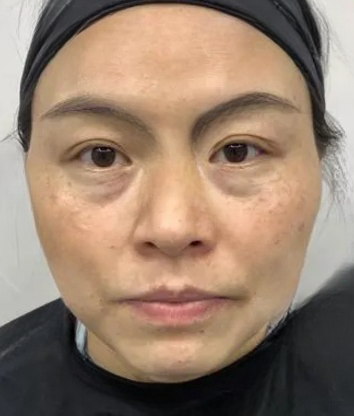 去眼袋手术