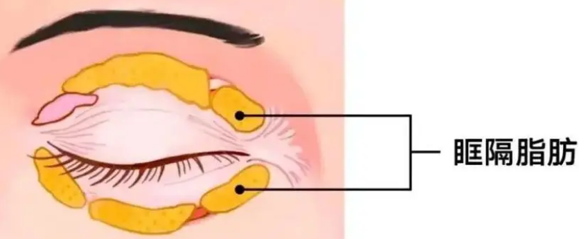 眼袋