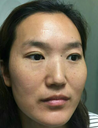 眼袋