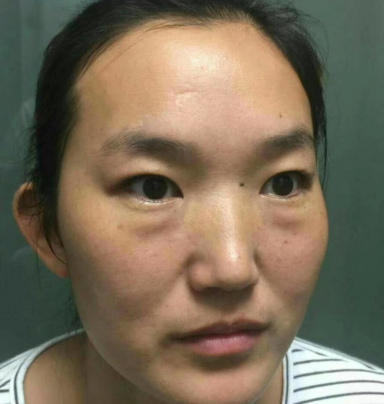 眼袋