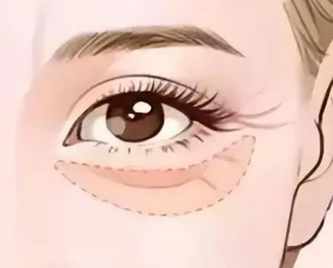 眼袋