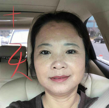去眼袋手术
