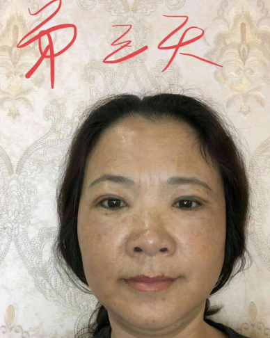 去眼袋手术
