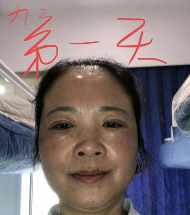 去眼袋手术