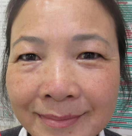 去眼袋手术