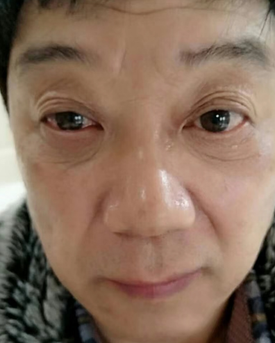 眼袋