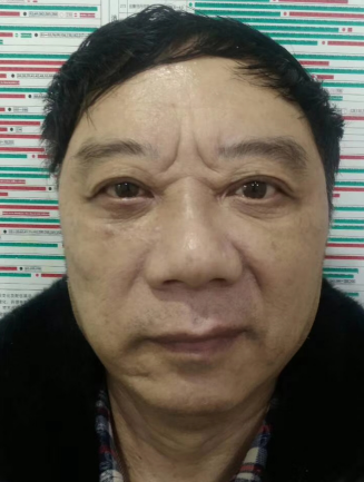 眼袋