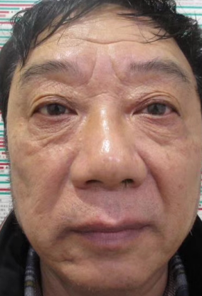 眼袋
