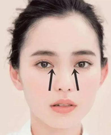 眼袋