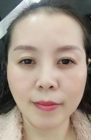 眼袋