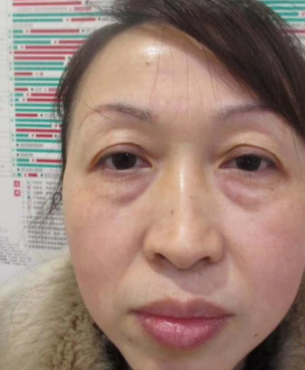 眼袋