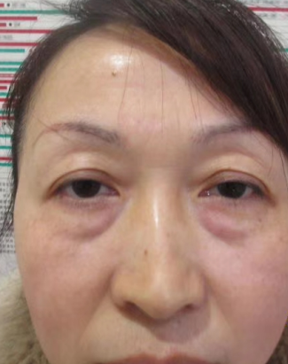 眼袋