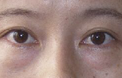 眼袋