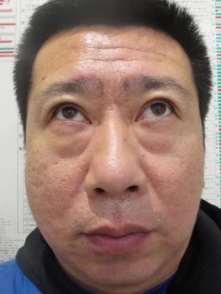眼袋