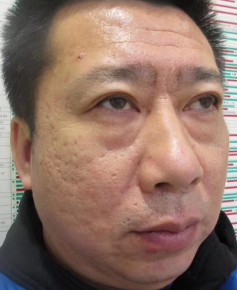 眼袋