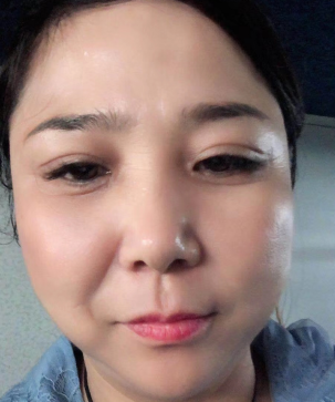 去眼袋手术