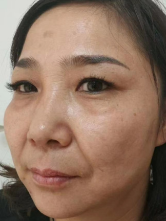 去眼袋手术