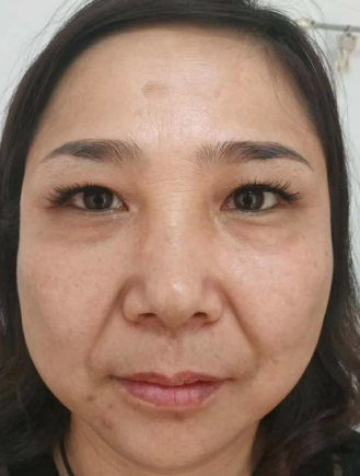 去眼袋手术