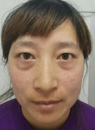 眼袋