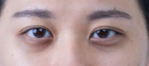 眼袋