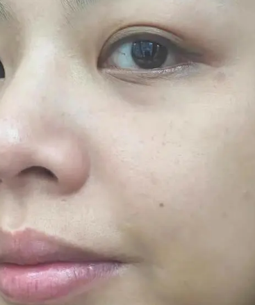 眼袋