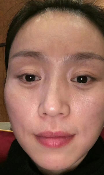 眼袋