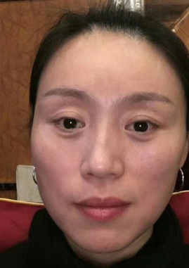 眼袋