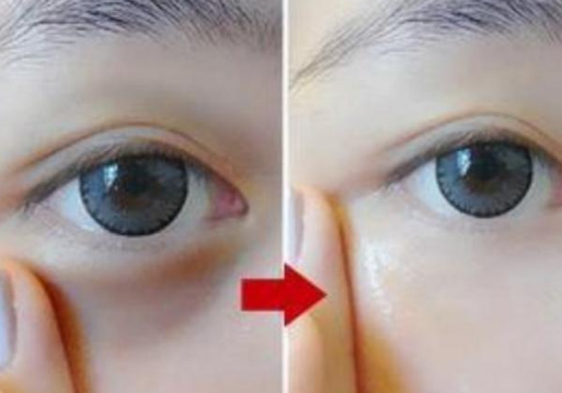 眼袋