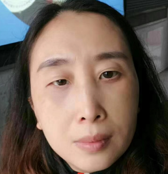 眼袋