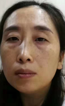 眼袋