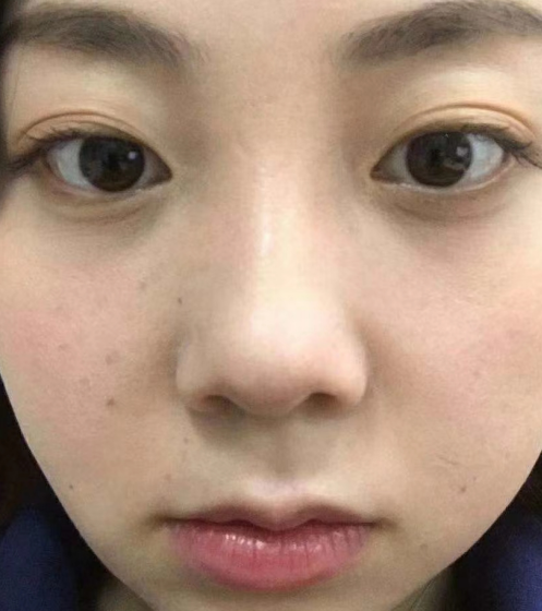 去眼袋手术