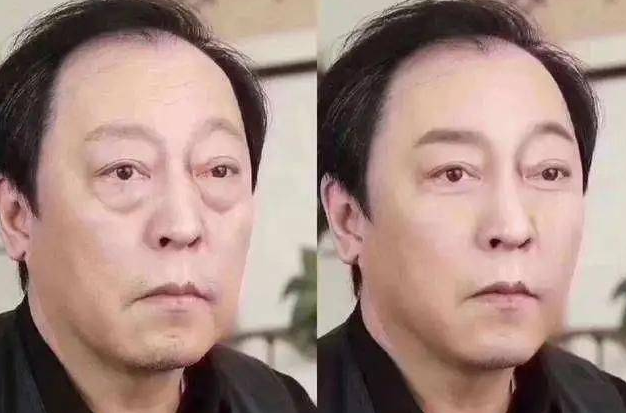 眼袋手术