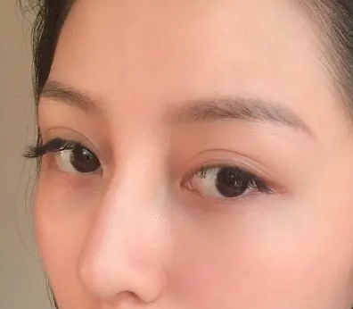 眼袋手术