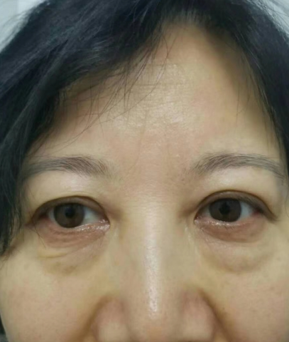 眼袋手术