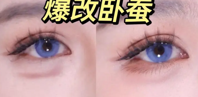 泪沟