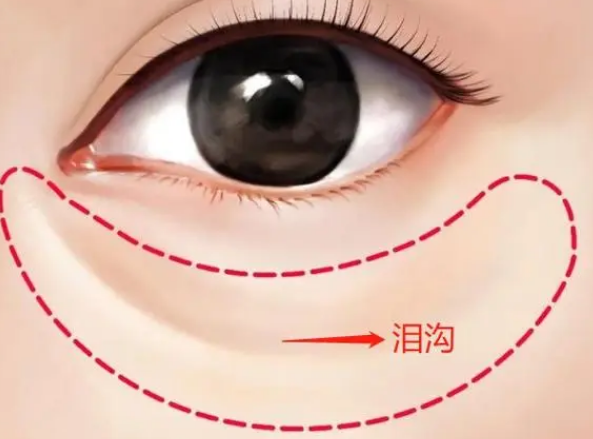 泪沟