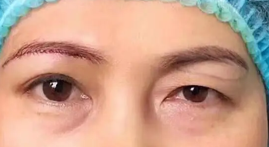 提眉