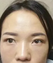 眼袋