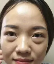 眼袋