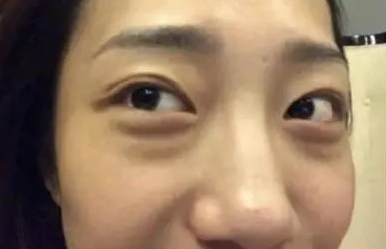 眼袋