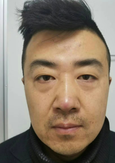 眼袋
