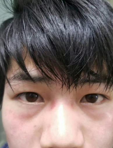 眼袋