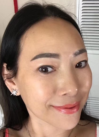 去眼袋手术