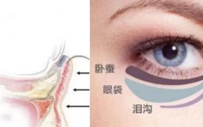 去眼袋手术