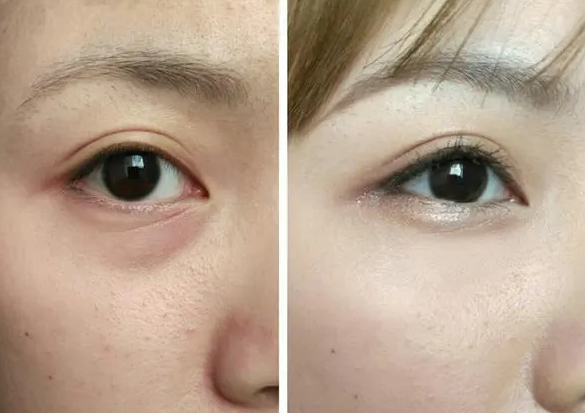 去眼袋手术