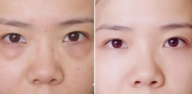 去眼袋手术