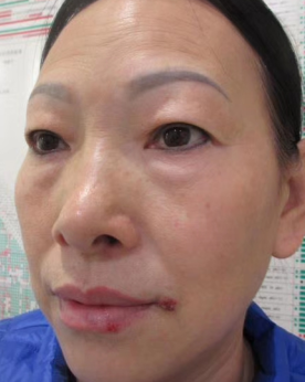 去眼袋手术