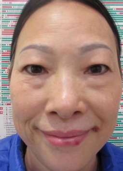 去眼袋手术